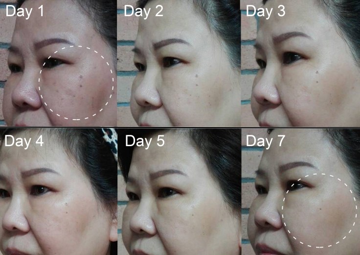 Lutronic Ruvy Freckles daily progress