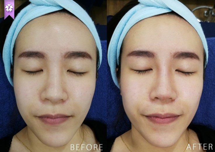 Nose Thread Lift Beau &amp; Hans