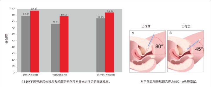incontilase beau&amp;hans 2_Chinese