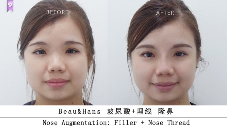 nose augmentation beau&amp;hans