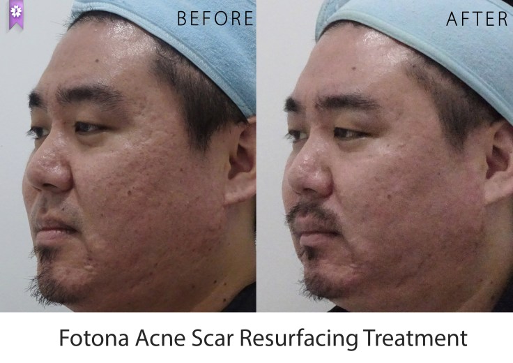 before after side_mix01