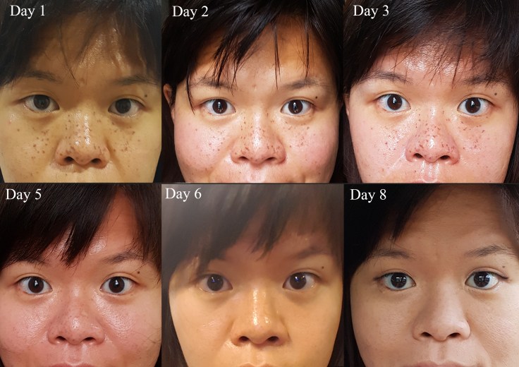 MY ruvy laser daily progress beau&amp;hans