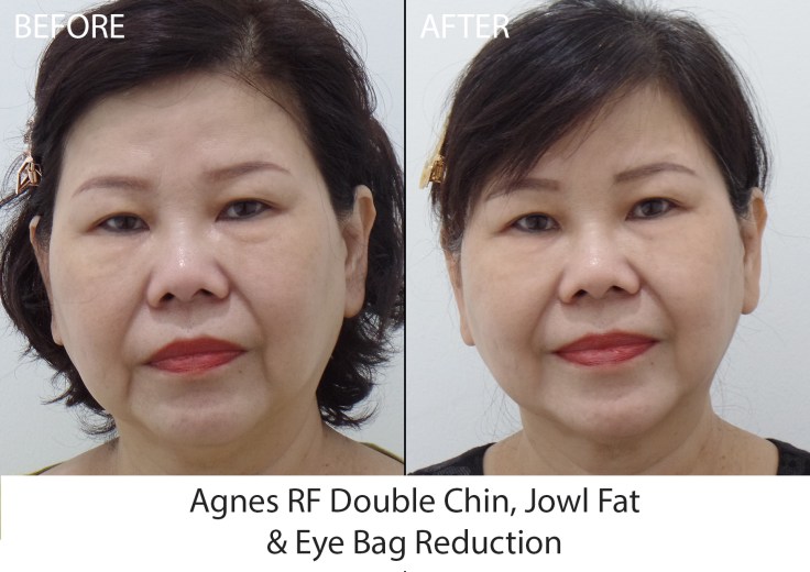 Agnes Treatment front