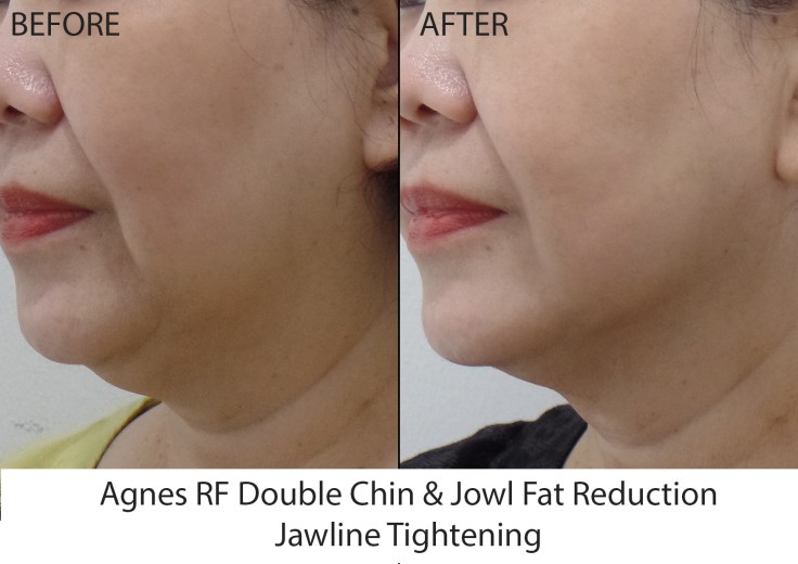 Agnes Treatment right